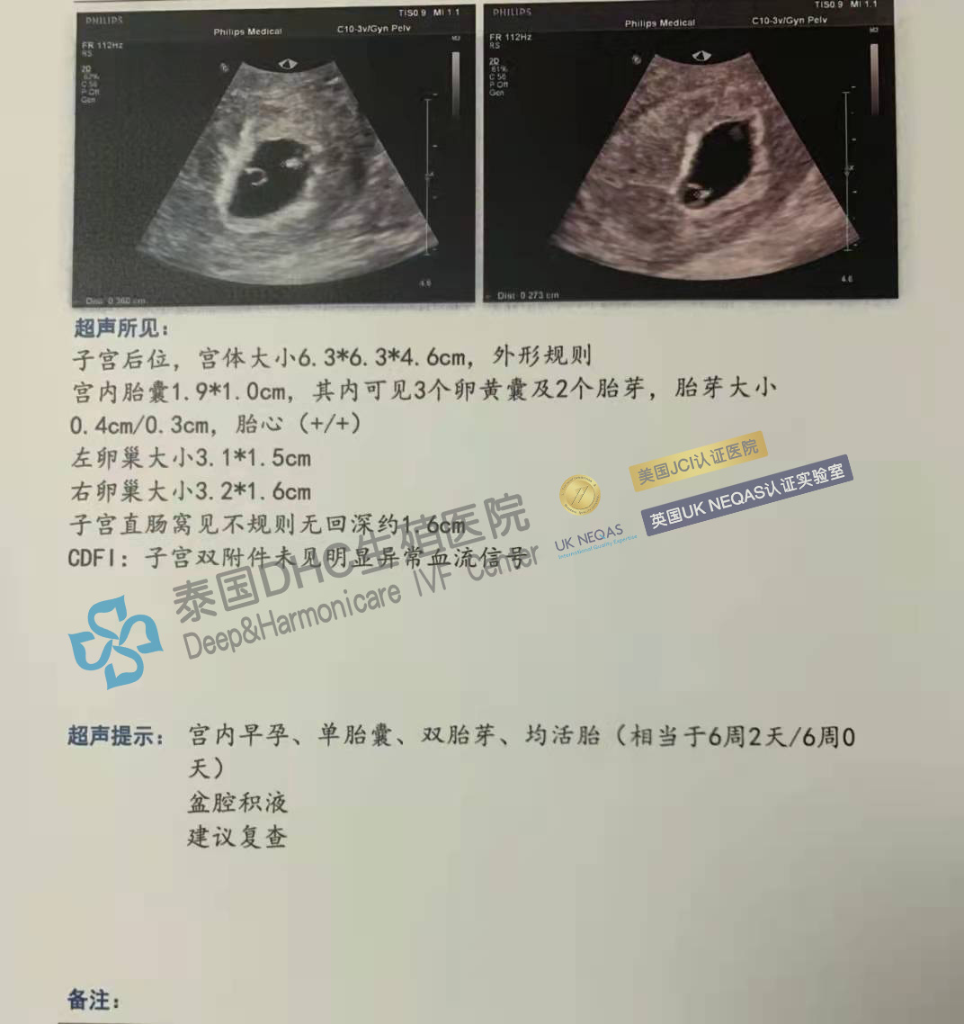 泰国第三代试管婴儿